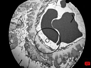  M,63y. | membranous glomerulopathy - digital photo from the screen